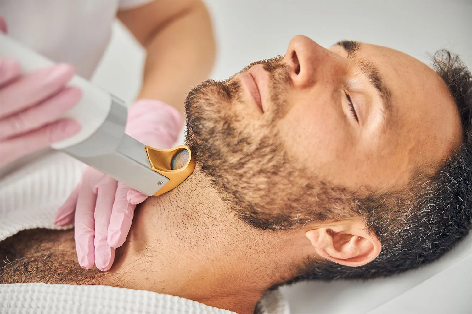 Beard hair transplantation process 1