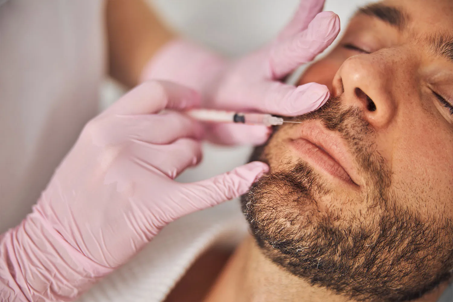 Beard hair transplantation process 2