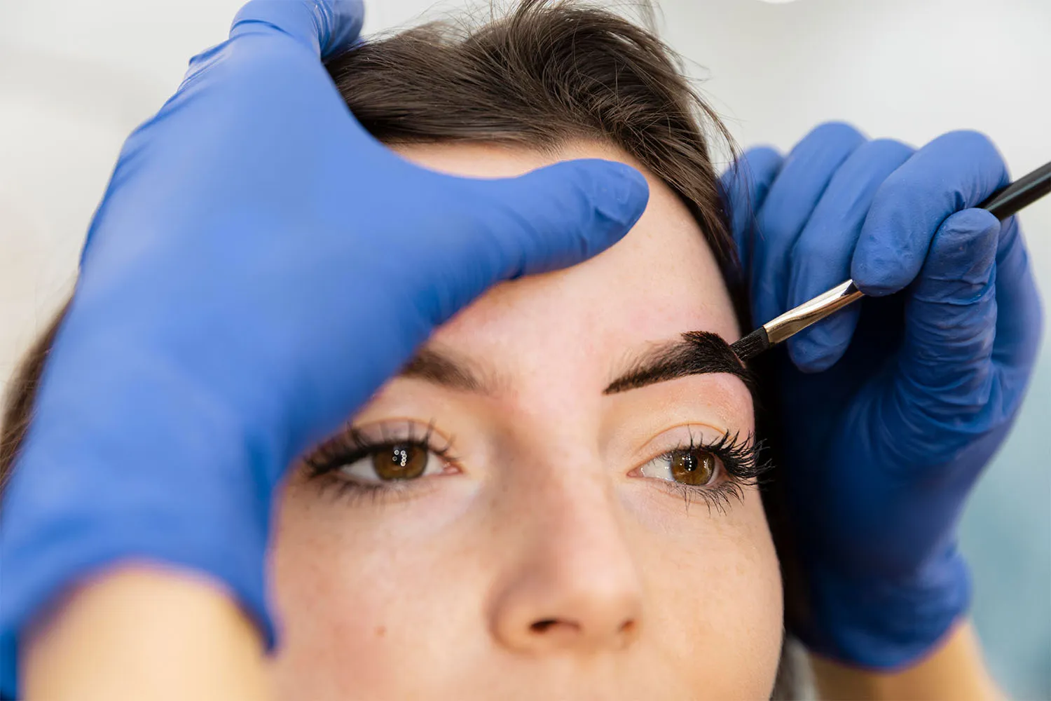 Eyebrow transplantation 2