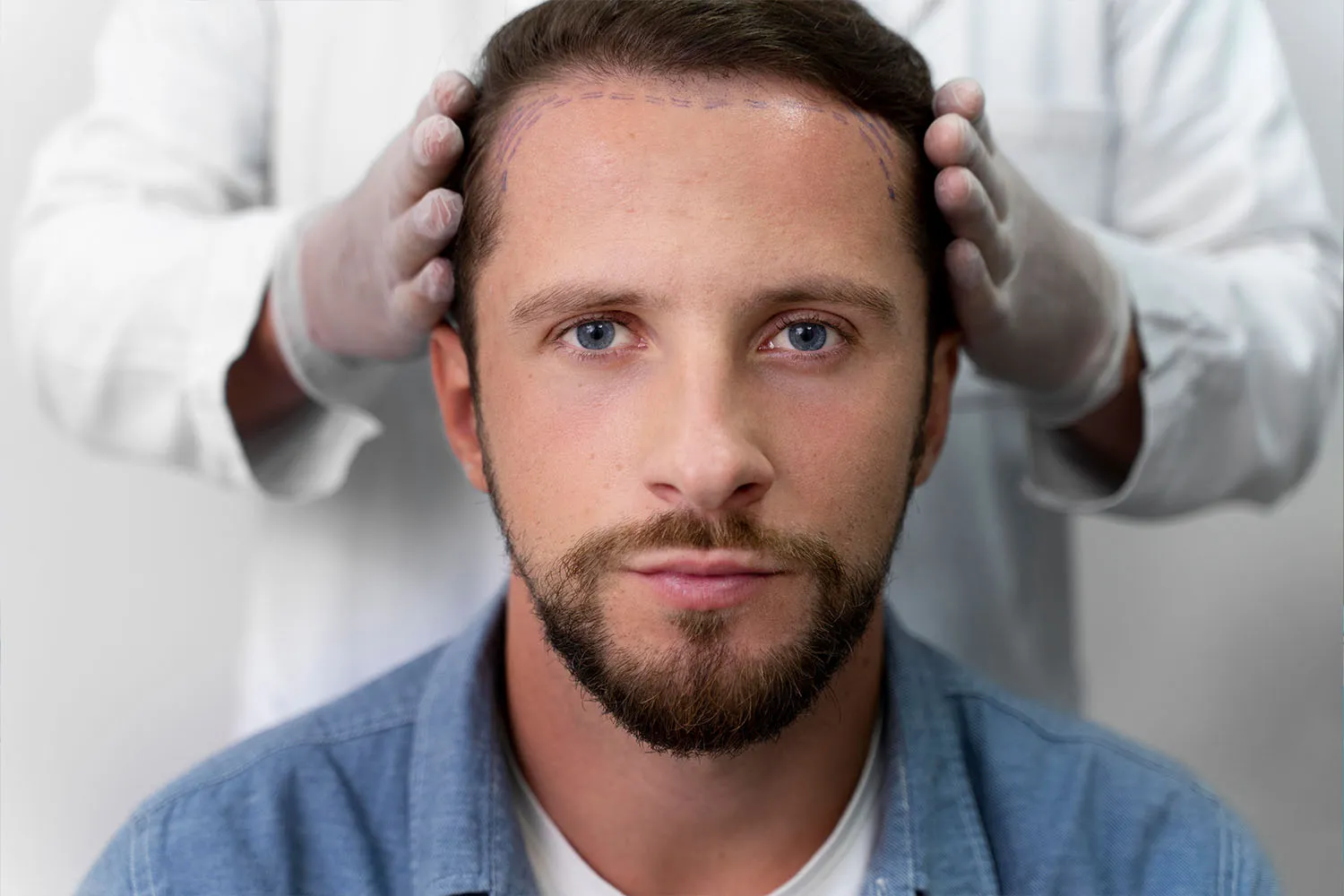 Hair transplant for men 1