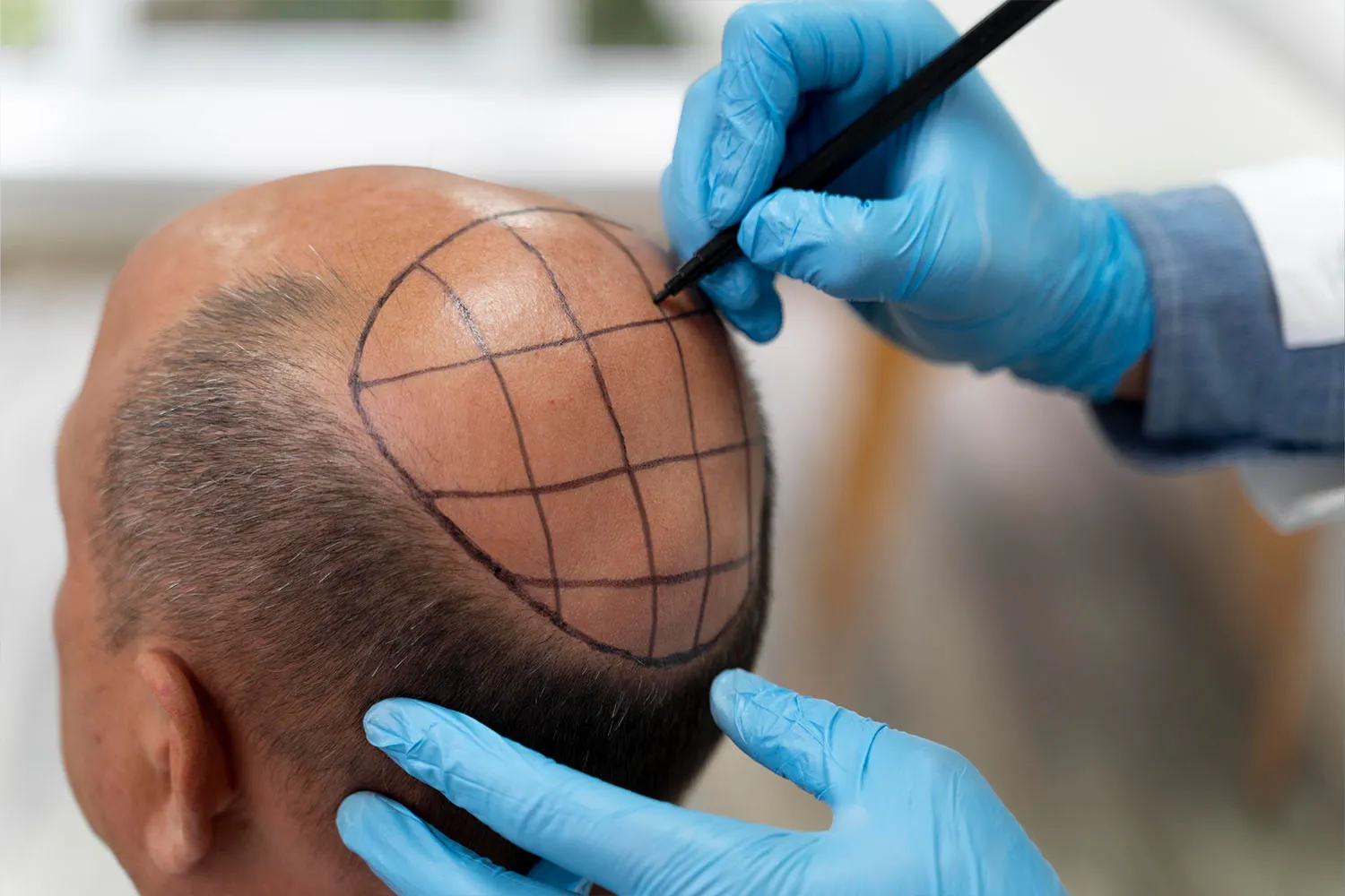 Hair transplant for men 2